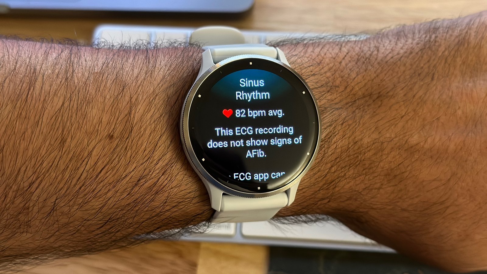 An ECG summary page on the Garmin Venu 3 saying the author's sinus rhythm is normal